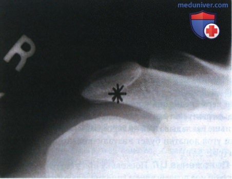 Укладка при рентгенограмме акромиально-ключичного сустава в ПЗ проекции