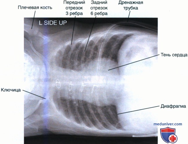 Укладка при рентгенограмме органов грудной клетки (ОГК) новорожденных и грудных детей лежа на боку