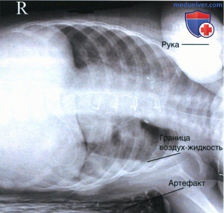 Рекомендации по анализу рентгенограммы органов грудной клетки (ОГК) новорожденных и грудных детей лежа на боку