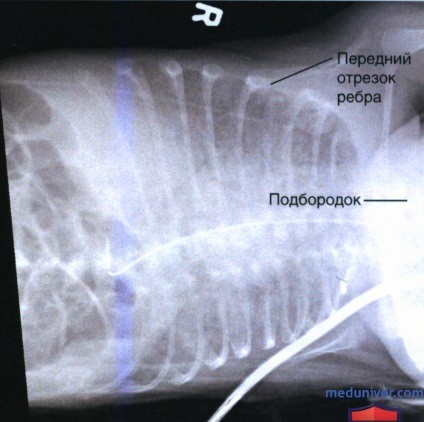 Рекомендации по анализу рентгенограммы органов грудной клетки (ОГК) новорожденных и грудных детей лежа на боку