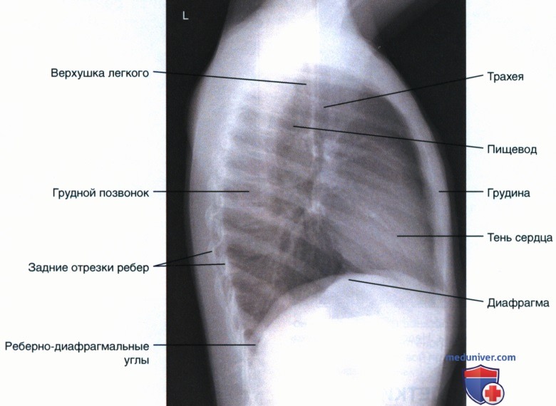 Укладка при рентгенограмме органов грудной клетки (ОГК) у детей старшего возраста в левой боковой проекции