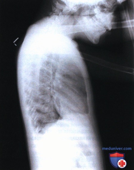 Рекомендации по анализу рентгенограммы органов грудной клетки (ОГК) у детей старшего возраста в левой боковой проекции