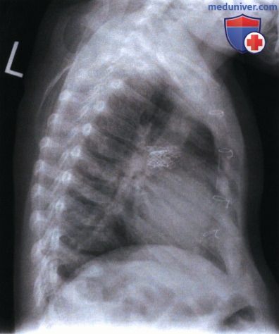 Рекомендации по анализу рентгенограммы органов грудной клетки (ОГК) у детей старшего возраста в левой боковой проекции