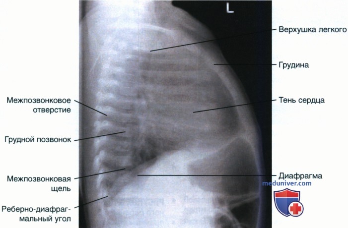 Укладка при рентгенограмме органов грудной клетки (ОГК) новорожденных и грудных детей при латерографии в левой боковой проекции
