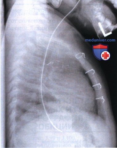 Рекомендации по анализу рентгенограммы органов грудной клетки (ОГК) новорожденных и грудных детей при латерографии в левой боковой проекции