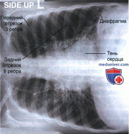 Укладка при рентгенограмме органов грудной клетки (ОГК) у детей старшего возраста лежа на боку