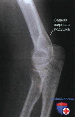 Укладка при рентгенограмме локтевого сустава в боковой проекции (латеромедиальной)