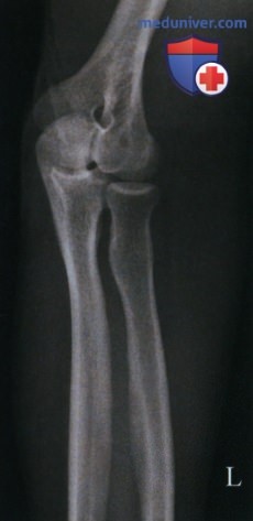 Укладка при рентгенограмме локтевого сустава в косой передне-задней проекции (ПЗ проекции)