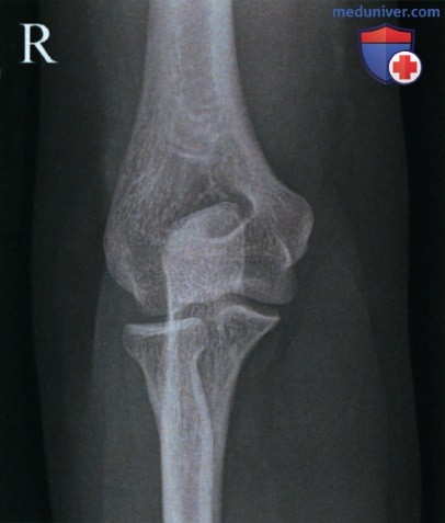 Укладка при рентгенограмме локтевого сустава в косой передне-задней проекции (ПЗ проекции)