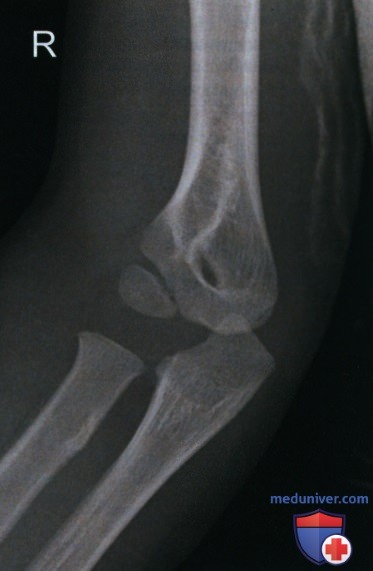 Укладка при рентгенограмме локтевого сустава в передне-задней проекции (ПЗ проекции)