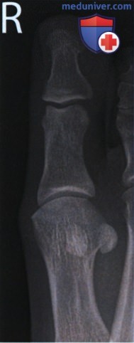 Укладка при рентгенограмме пальца стопы в косой ПЗ проекции