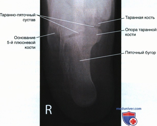 Рекомендации по анализу рентгенограммы пяточной кости в аксиальной проекции (плантодорсальной)