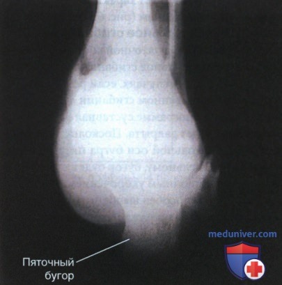 Рекомендации по анализу рентгенограммы пяточной кости в аксиальной проекции (плантодорсальной)