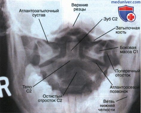 Укладка при рентгенограмме первого и второго шейного позвонка (атланта, осевого позвонка) в ПЗ проекции