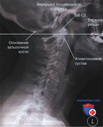 Рентгенограмма первого и второго шейного позвонка (атланта, осевого позвонка) в ПЗ проекции