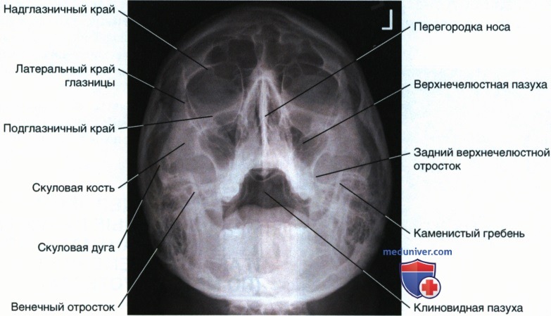 Укладка при рентгенограмме лицевого отдела черепа, придаточных пазух в теменно-акантиальной и акантио-теменной проекции по методу Уотерса