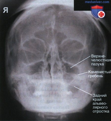 Рентгенограмма лицевого отдела черепа, придаточных пазух в теменно-акантиальной и акантио-теменной проекции по методу Уотерса