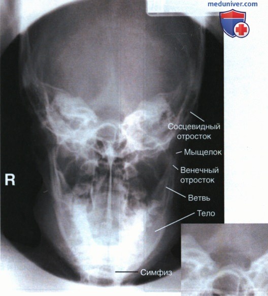 Укладка при рентгенограмме черепа и нижней челюсти в аксиальной ПЗ проекции по методу Тауна