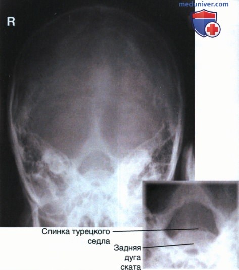 Рентгенограмма черепа и нижней челюсти в аксиальной ПЗ проекции по методу Тауна