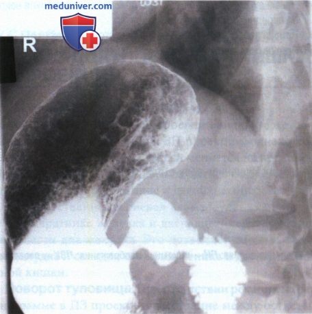 Рентгенограмма желудка и двенадцатиперстной кишки в боковой проекции