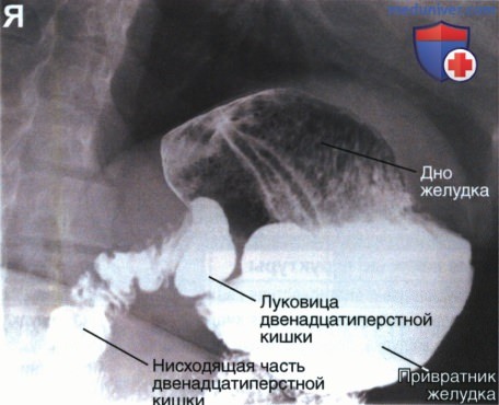 Рентгенограмма желудка и двенадцатиперстной кишки в косой ЗП проекции