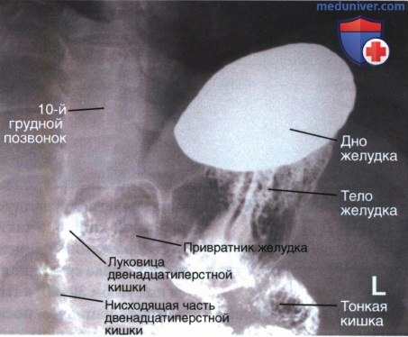 Рентгенограмма желудка и двенадцатиперстной кишки в косой ПЗ проекции
