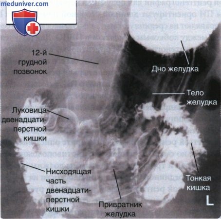 Рентгенограмма желудка и двенадцатиперстной кишки в ПЗ проекции