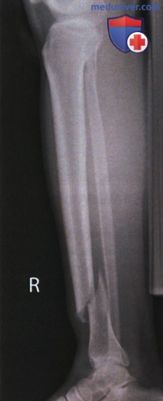 Укладка при рентгенограмме голени в боковой проекции (медиолатеральной)