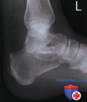 Укладка при рентгенограмме голеностопного сустава в боковой проекции (медиолатеральной)