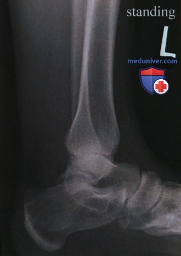 Укладка при рентгенограмме голеностопного сустава в боковой проекции (медиолатеральной)