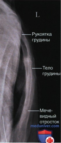 Укладка при рентгенограмме грудины в боковой проекции