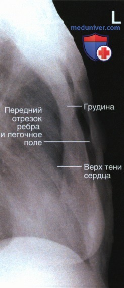Рентгенограмма грудины в боковой проекции