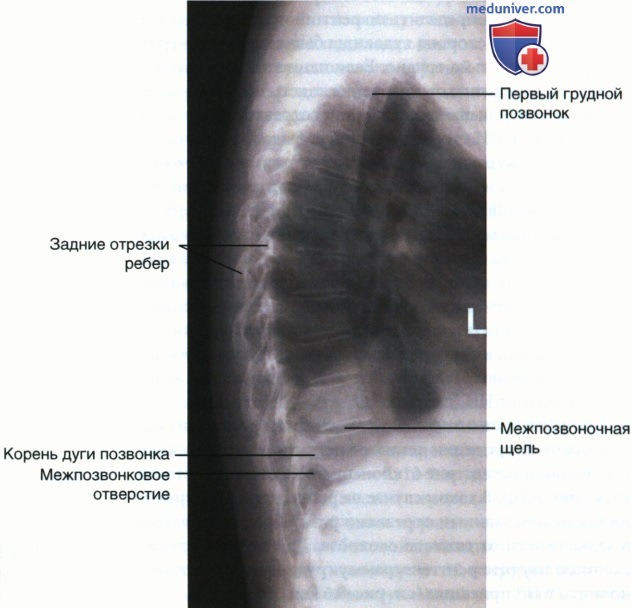 Укладка при рентгенограмме грудных позвонков в боковой проекции