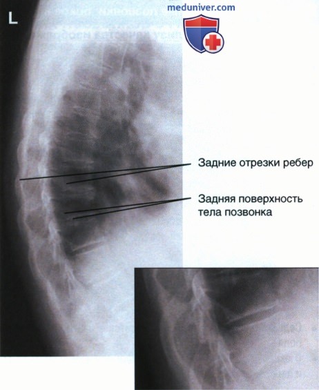 Рентгенограмма грудных позвонков в боковой проекции