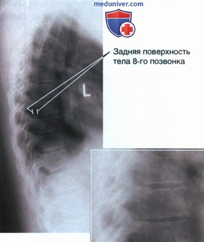 Рентгенограмма грудных позвонков в боковой проекции