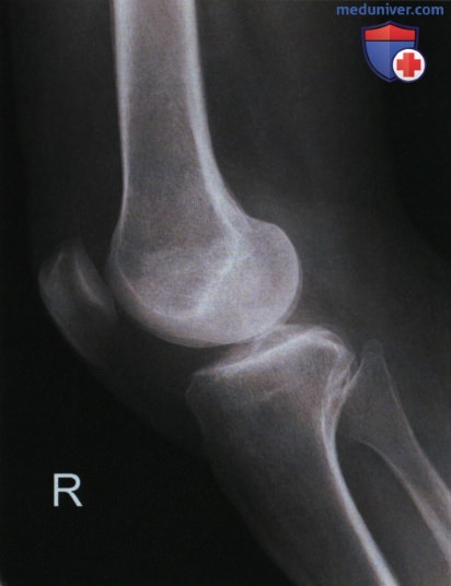 Укладка при рентгенограмме коленного сустава в боковой проекции (медиолатеральной)