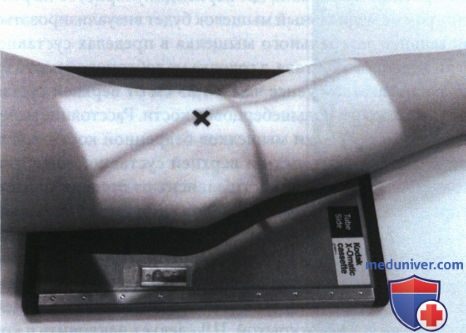 Укладка при рентгенограмме коленного сустава в боковой проекции (медиолатеральной)