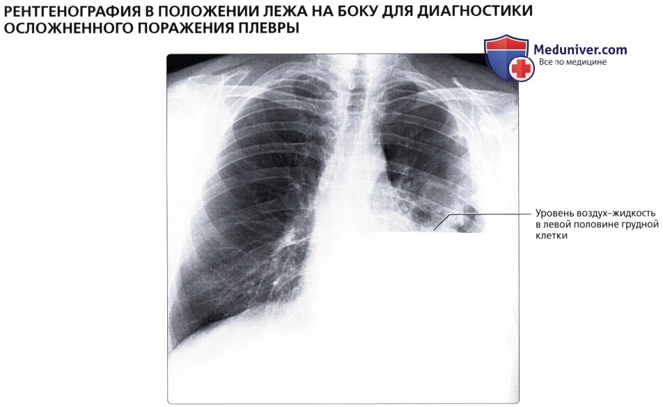 Рентген органов грудной клетки лежа на боку: укладка, коллимация