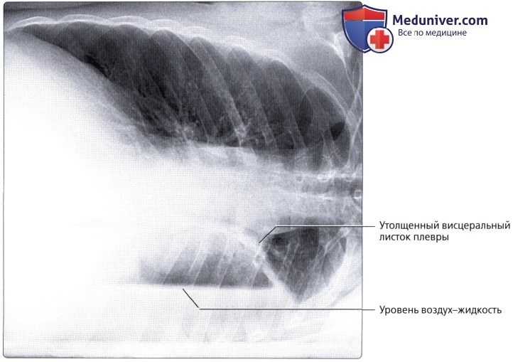 Рентген органов грудной клетки лежа на боку: укладка, коллимация
