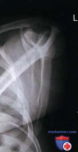 Укладка при рентгенограмме лопатки в боковой проекции (латеромедиальной, медиолатеральной)