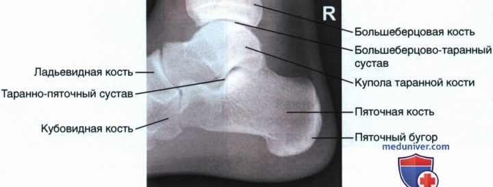 Укладка при рентгенограмме пяточной кости в боковой проекции (медиолатеральной)