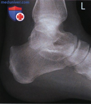 Укладка при рентгенограмме пяточной кости в боковой проекции (медиолатеральной)