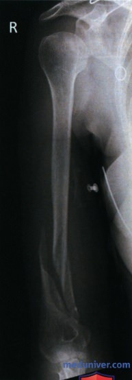 Укладка при рентгенограмме плечевой кости в передне-задней проекции (ПЗ проекции)