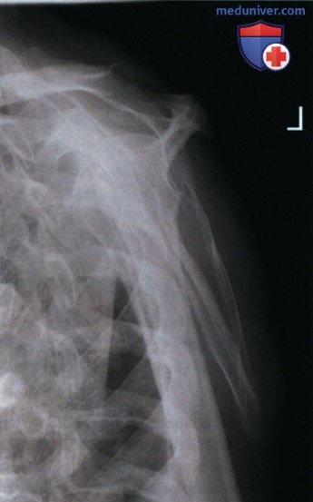 Укладка при рентгенограмме плечевого сустава в косой ЗП проекции (лопаточной Y проекции)