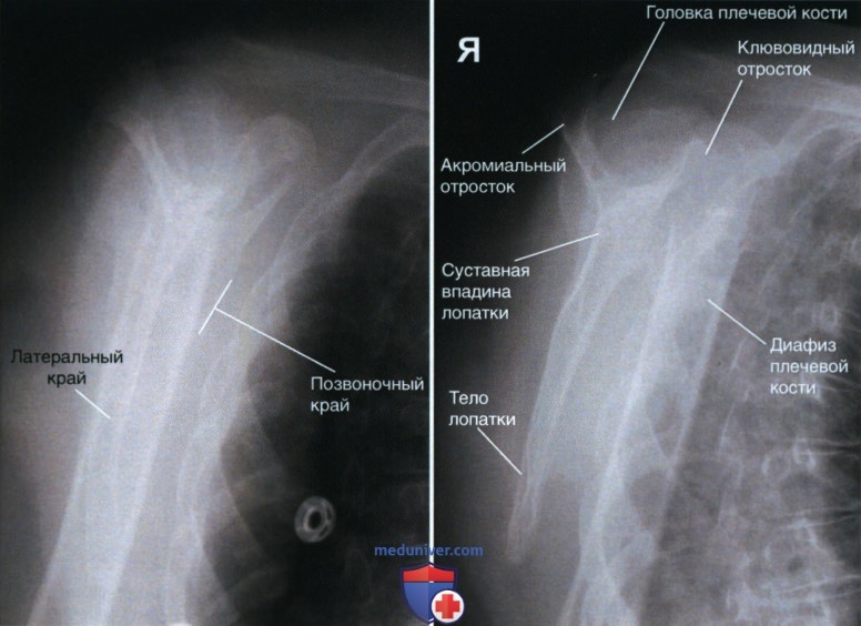 Укладка при рентгенограмме плечевого сустава в косой ЗП проекции (лопаточной Y проекции)