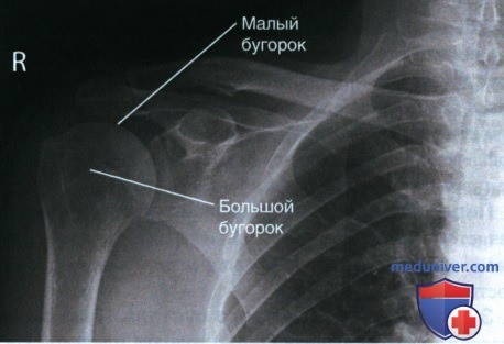 Укладка при рентгенограмме плечевого сустава в передне-задней проекции (ПЗ проекции)
