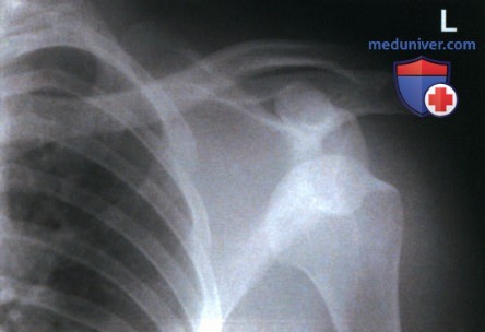 Укладка при рентгенограмме плечевого сустава в передне-задней проекции (ПЗ проекции)