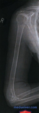 Укладка при рентгенограмме плечевой кости в боковой проекции