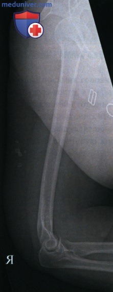 Укладка при рентгенограмме плечевой кости в боковой проекции