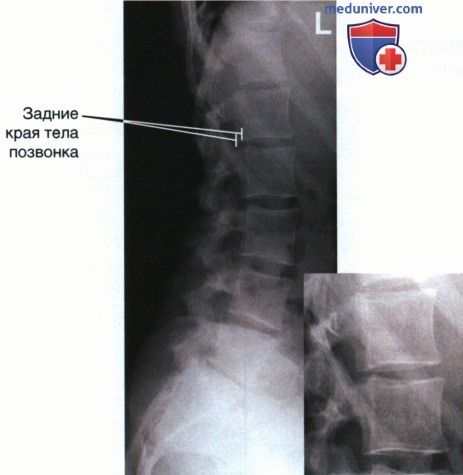 Рентгенограмма поясничных позвонков в боковой проекции